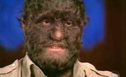 Abnormálním lidé. S takovými deformacemi museli žít 36