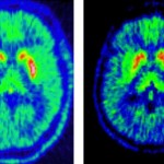 Průlomová studie zjistila významné změny mozku po mírném covidu-19 3