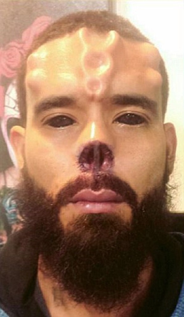 Comic Book Fan Has Nose Chopped Off to Look Like Villain Red Skull