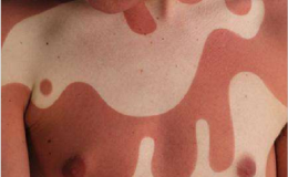 Nejhloupější trend současnosti? Lidé se nechávají spálit Sluncem 2