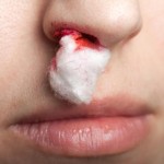 Jak zastavit krvácení z nosu? 3