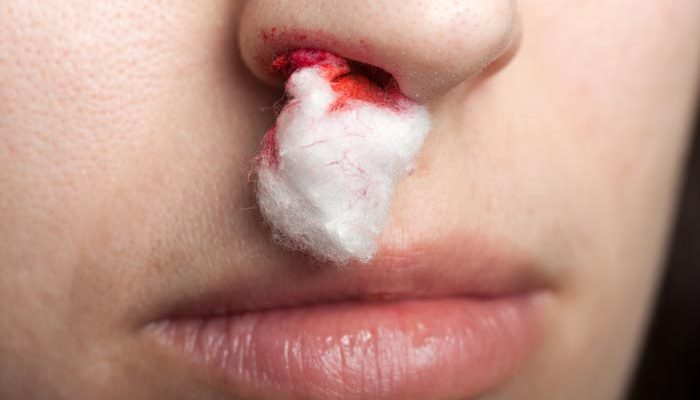 Jak zastavit krvácení z nosu? 1